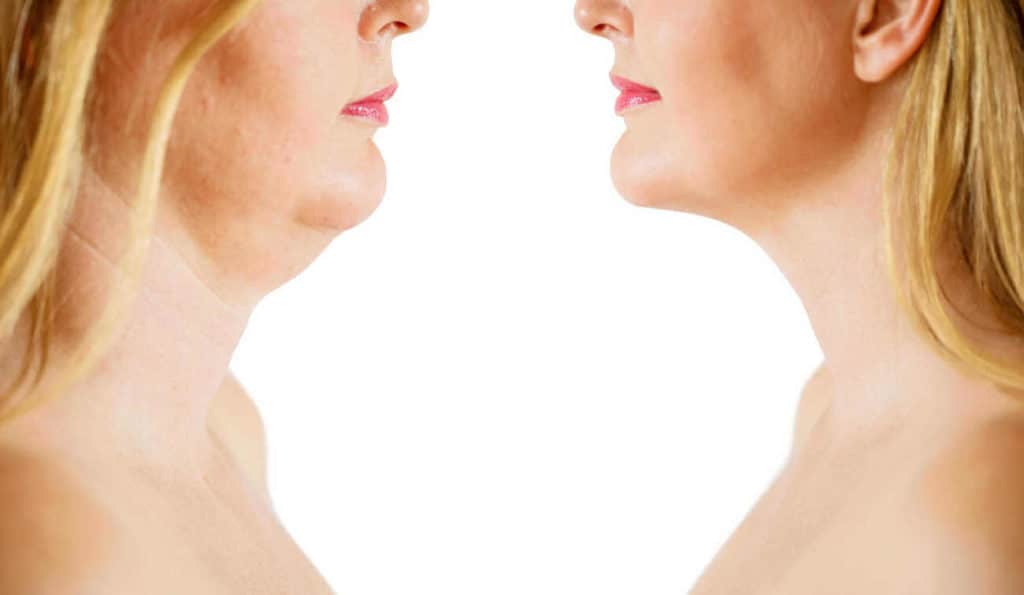 Double Chin treatment Queensbury before and after results