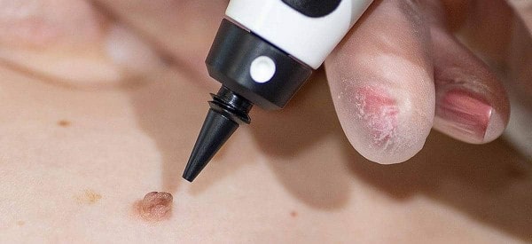 After Skin Tag Removal Queensbury