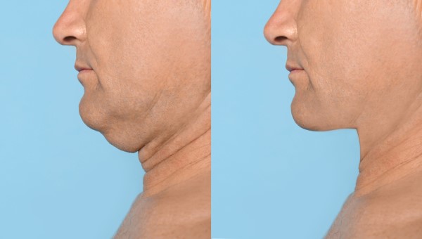 Which Non-Surgical Treatments Work Best for Jowls and Loose Skin Queensbury?