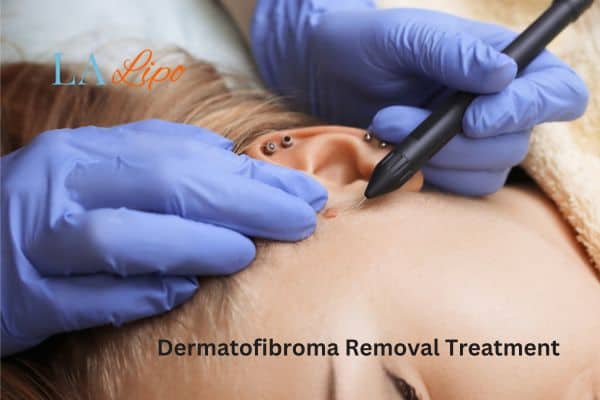 Dermatofibroma Removal Treatment Queensbury
