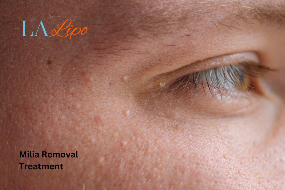 Cryopen Milia Removal: Is It the Easiest and Safest Option Queensbury?