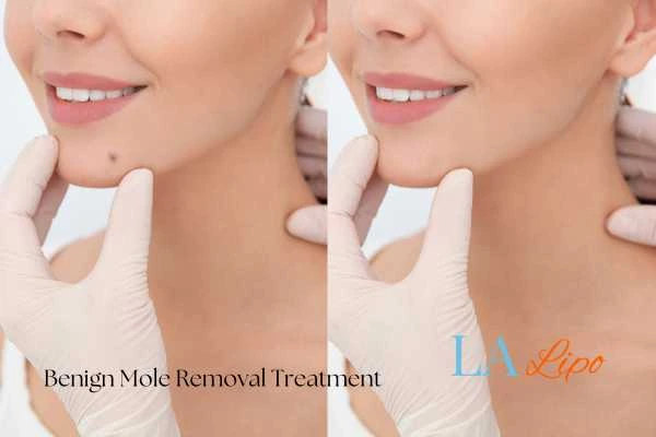 woman's before and after mole removal Queensbury results