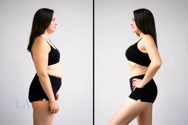 image of woman before and after results of LA-EMS Body Sculpting Queensbury to help treat Diastasis recti