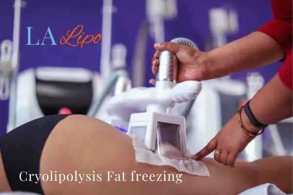 women getting fat freezing Queensbury