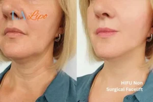 hi-fu for wrinkles Queensbury before and after results