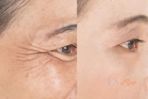 Before and after results of woman - HI-fu wrinkles reduction treatment Queensbury