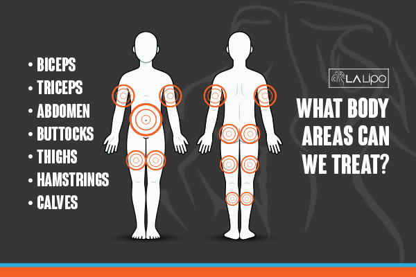 Graphic to show areas you can have LA-EMS Body Sculpting Queensbury treatment.