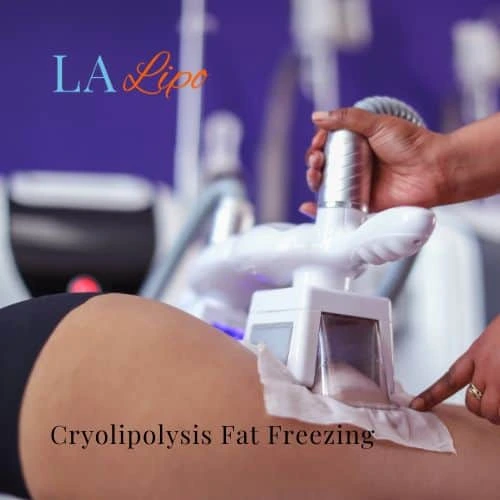 fat freezing - Cryolipolysis Queensbury