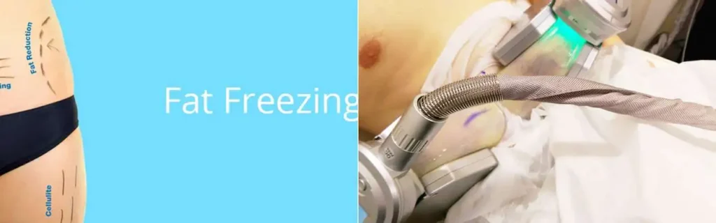 Fat freezing Queensbury on multiple areas of the body