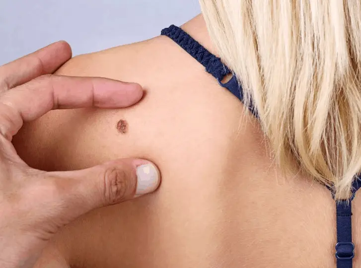 woman having mole removal Queensbury consultation before treatment.
