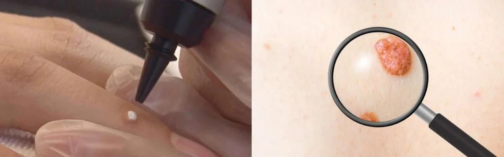 CryoPen practitioner Queensbury assessing a benign mole before treatment