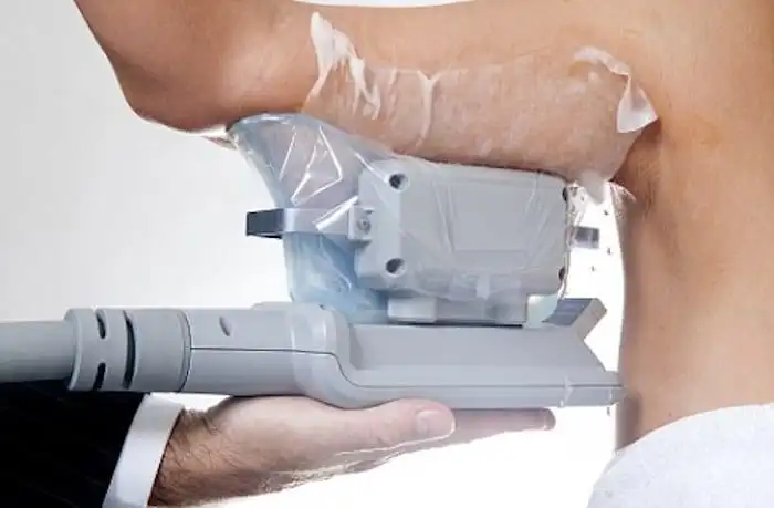 Picture of fat freezing Queensbury on the upper arms.