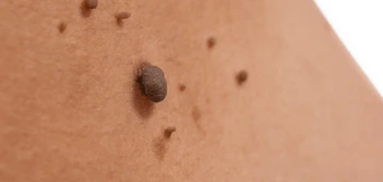 image of a skin tag Queensbury
