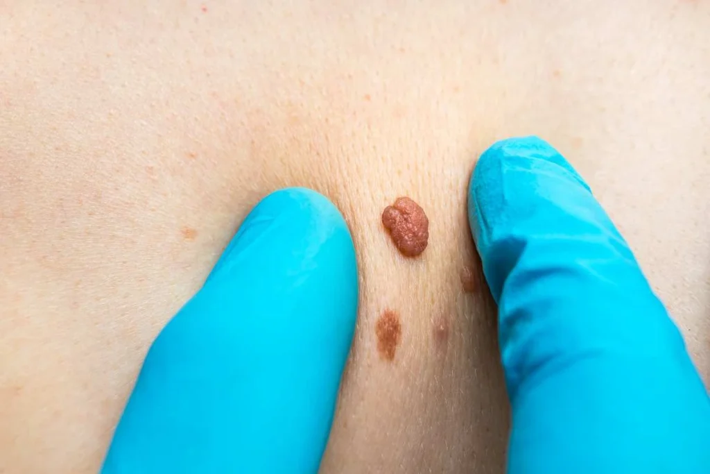 Consultant examining a skin tag Queensbury
