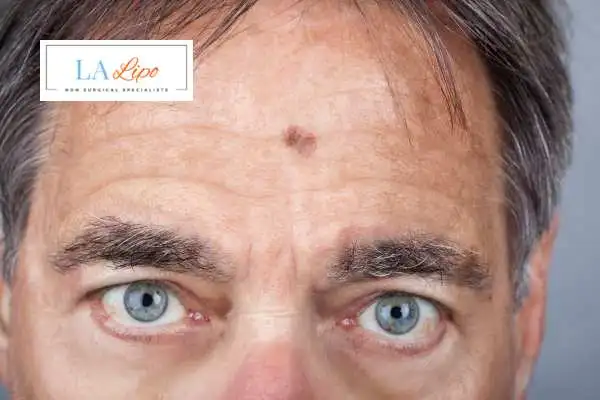 Solar Lentigo Removal Queensbury image of man with mark on his forehead