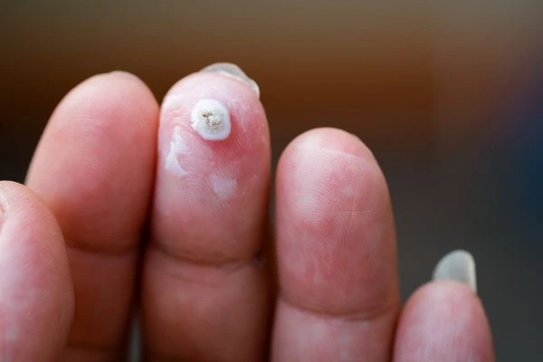 wart on person finger - cryotherapy to treat from LA LIPO Queensbury