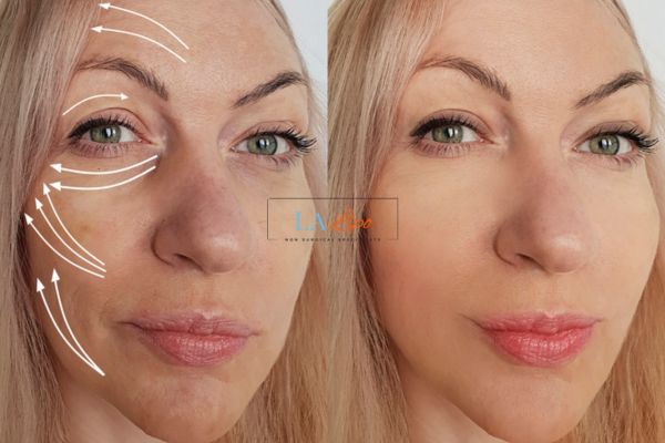 Morpheus 8 results Queensbury face lift.
