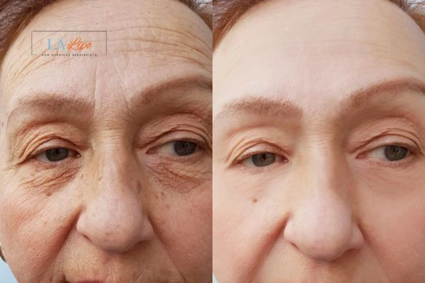 The powerful benefits of Morpheus8 Treatment Queensbury - Call Our team today!