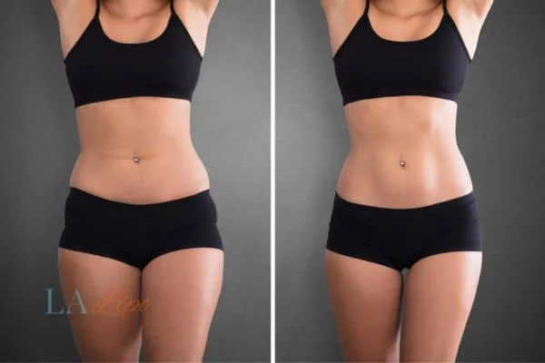 before and after results of non-surgical treatment to help a woman's body image and mental health Queensbury