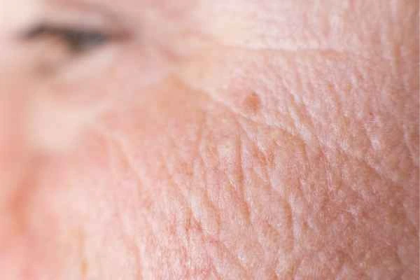 close up picture of a woman's face showing an age spot Queensbury