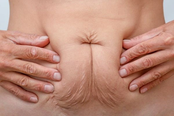 Image of a woman's stomach with loose skin - example of skin tightening Queensbury options