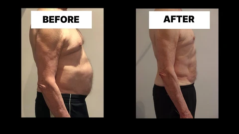 What Symptoms Can Diastasis Recti Cause in Men? Weak Core, Back Pain and Poor Posture Queensbury